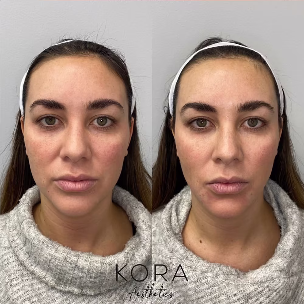 Before and after comparison demonstrating clearer skin pigmentation, improved texture, and enhanced facial volume in Scottsdale