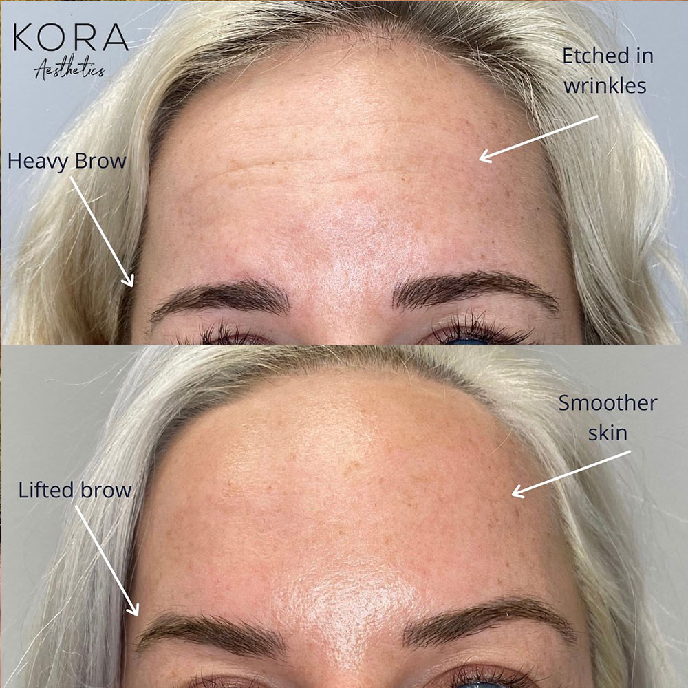 Annotated before and after photo showcasing transformation from heavy brows and etched wrinkles to smoother skin and lifted eyebrows in Scottsdale