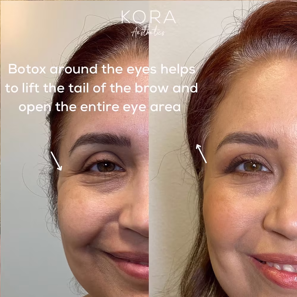 Close up before and after image demonstrating Botox around the eye area to lift the brow tail and soften crow's feet in Scottsdale