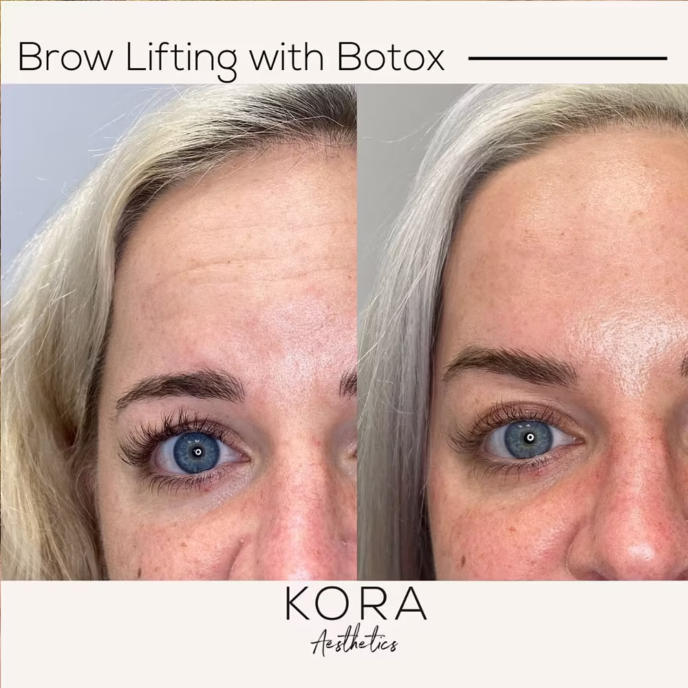 Before and after comparison of Botox brow lift treatment showing smoothed forehead wrinkles and elevated eyebrows in Scottsdale