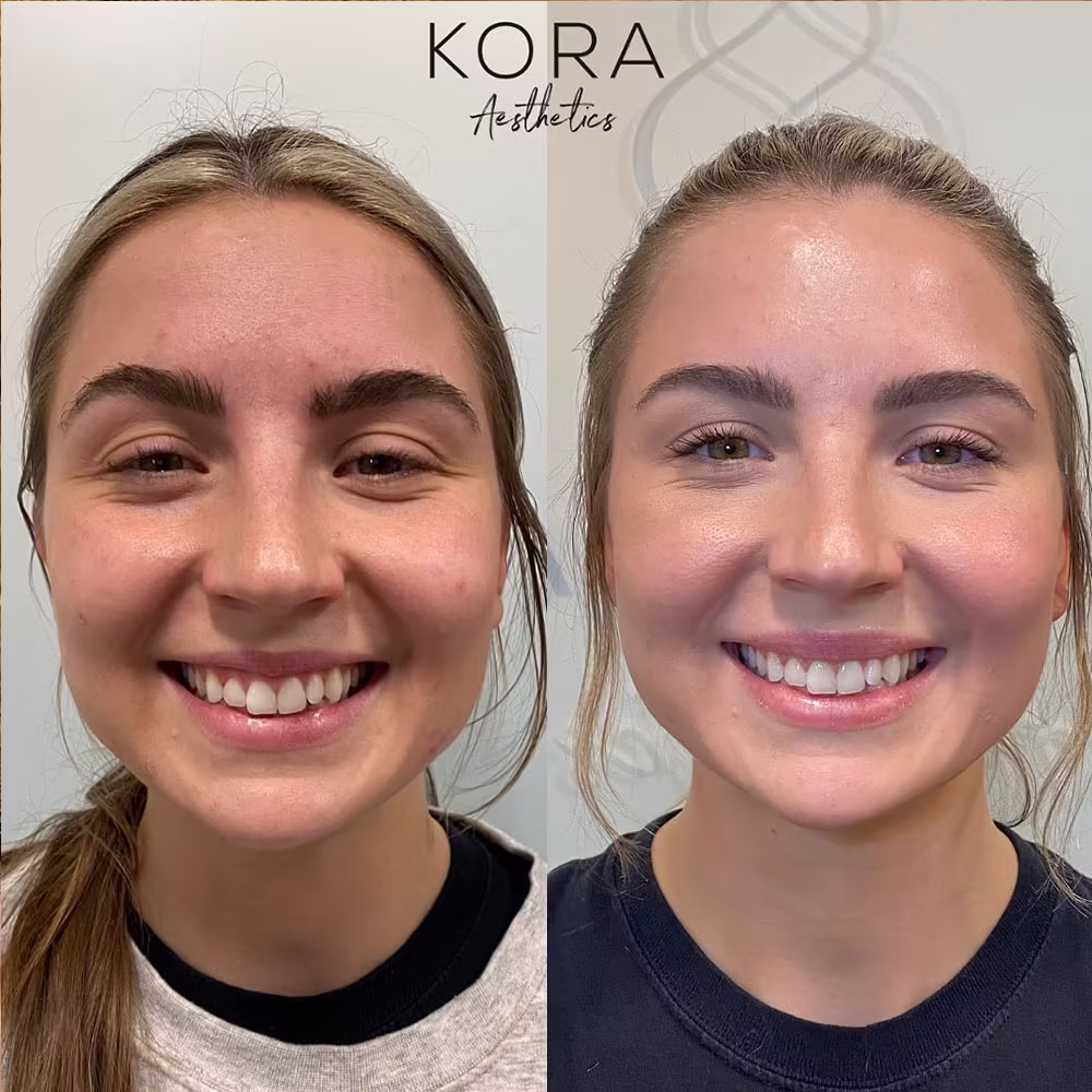Before and after comparison of Botox treatment showing smoothed crow's feet lines around the eyes while smiling in Scottsdale