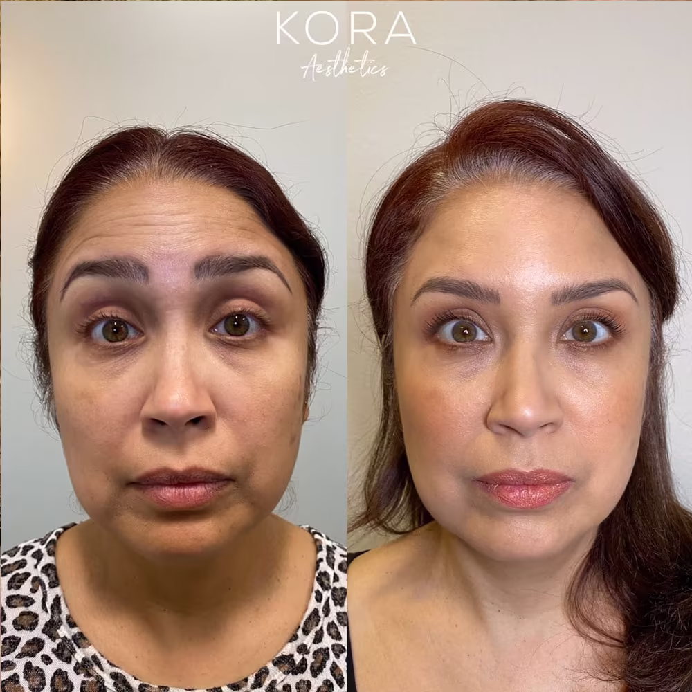 Before and after comparison of Botox treatment showing smoothed horizontal forehead lines and a refreshed facial complexion in Scottsdale