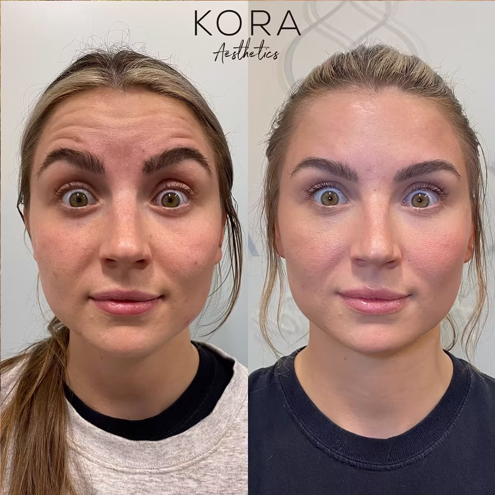 Before and after comparison of Botox frown lines treatment showing smoothed glabella and forehead creases in Scottsdale