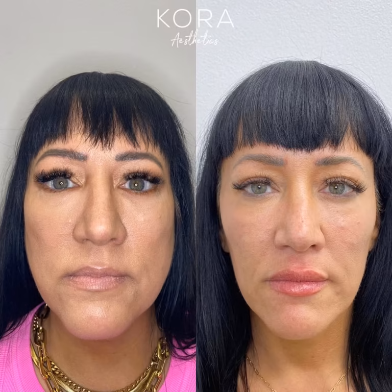Botox Jawline Slimming patient #323 before and after