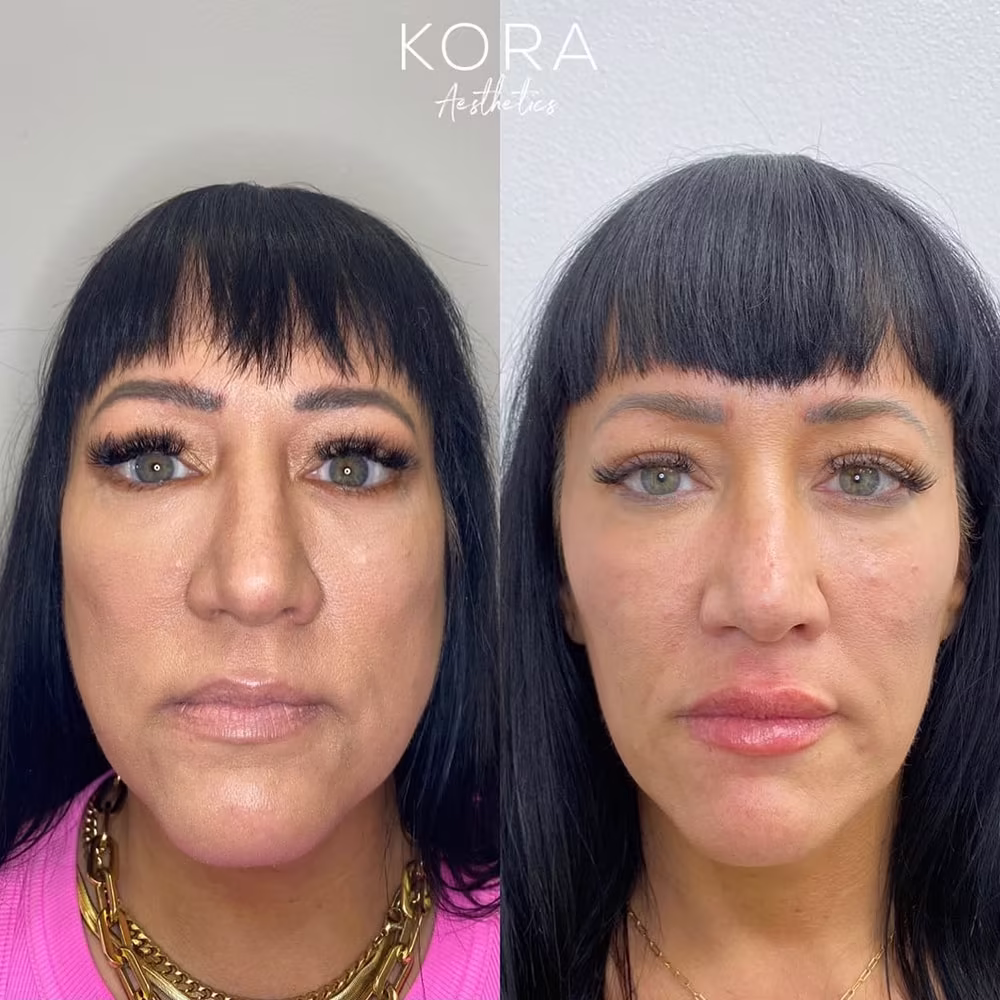 Frontal view before and after comparison of masseter Botox treatment showing noticeable jawline slimming in Scottsdale