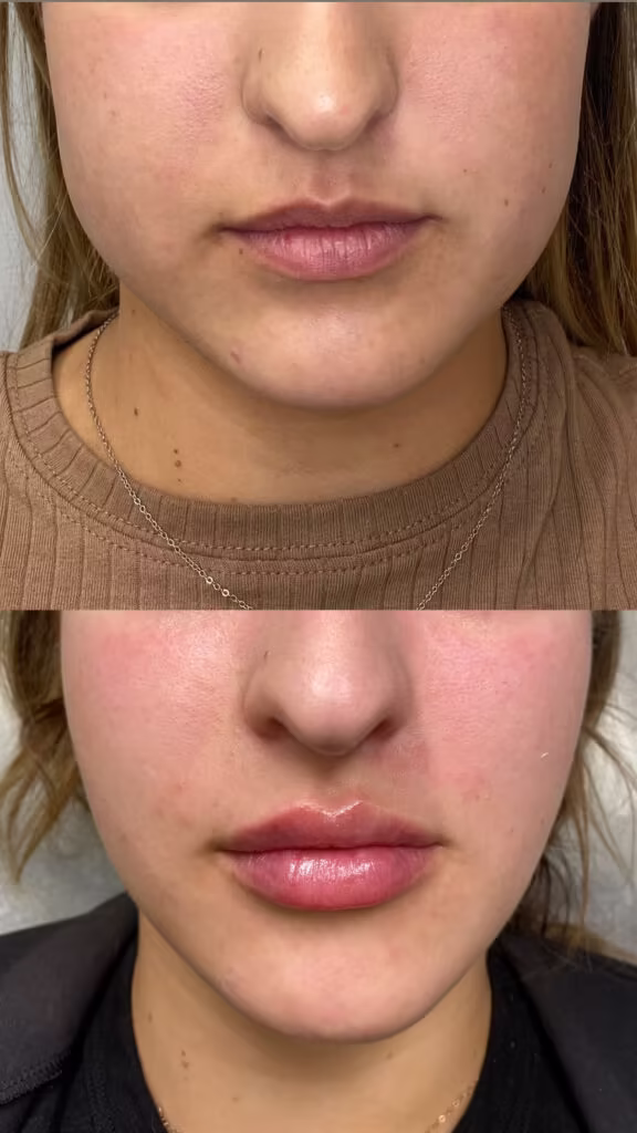 Before and after lower face close-up showing masseter jawline slimming and subtle lip enhancement in Scottsdale