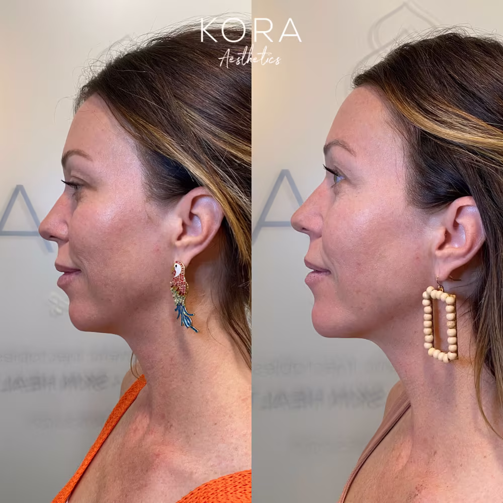 Side profile before and after view showing chin filler enhancing projection and lower facial balance in Scottsdale