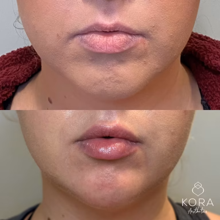 Dermal Filler Chin Fillers patient #371 before and after