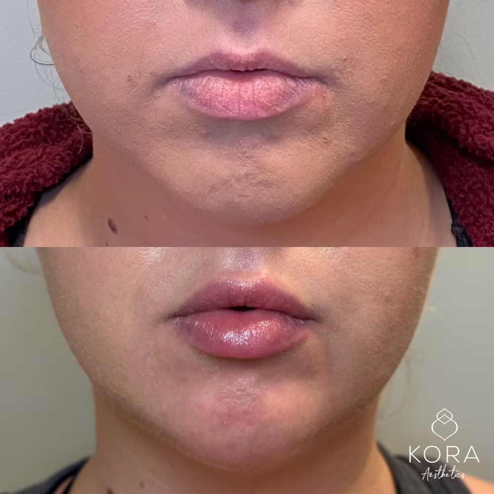 Frontal close-up before and after view demonstrating dermal filler treatment for chin elongation and lip enhancement in Scottsdale