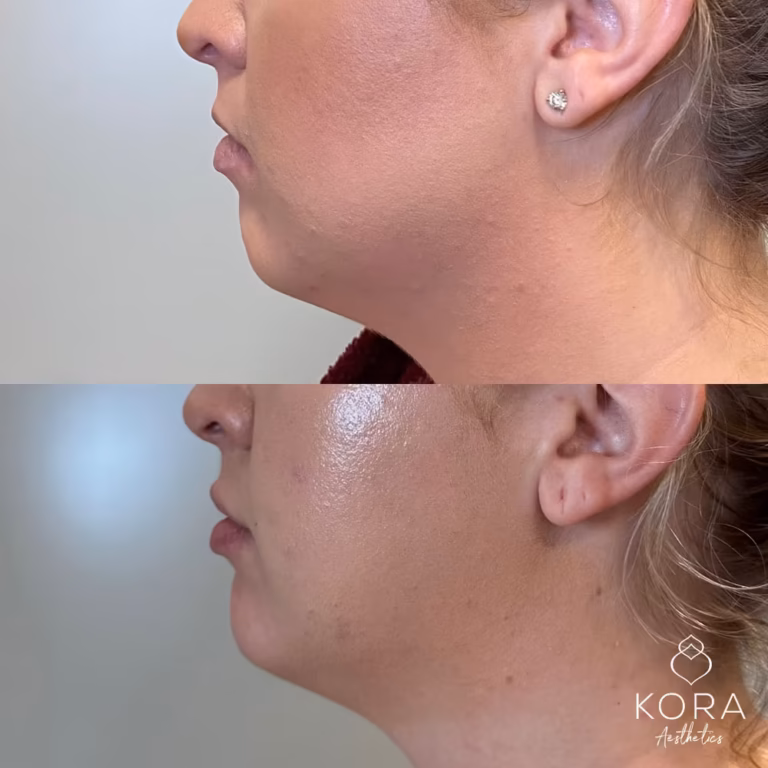 Dermal Filler Chin Fillers patient #370 before and after