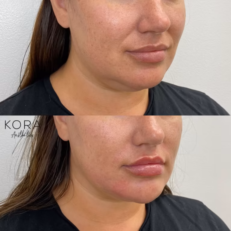Dermal Filler Chin Fillers patient #372 before and after
