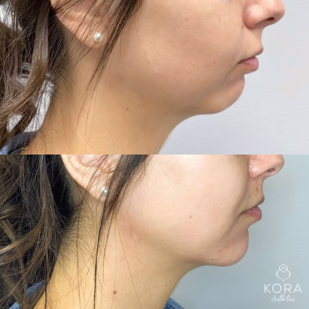 Profile before and after photo showcasing dermal filler augmenting the chin to improve submental profile balance in Scottsdale