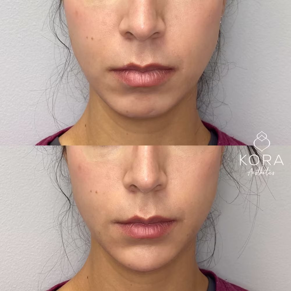 Frontal before and after close-up showing chin filler correcting lower face symmetry and elongating the chin in Scottsdale