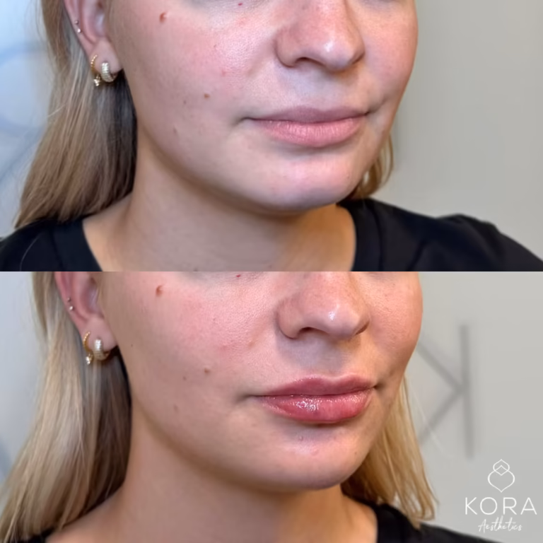 Dermal Filler Chin Fillers patient #377 before and after