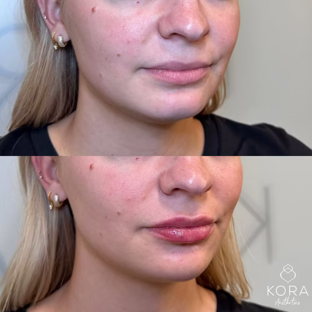 Three-quarter view before and after displaying dermal filler treatment for chin definition and lip enhancement in Scottsdale