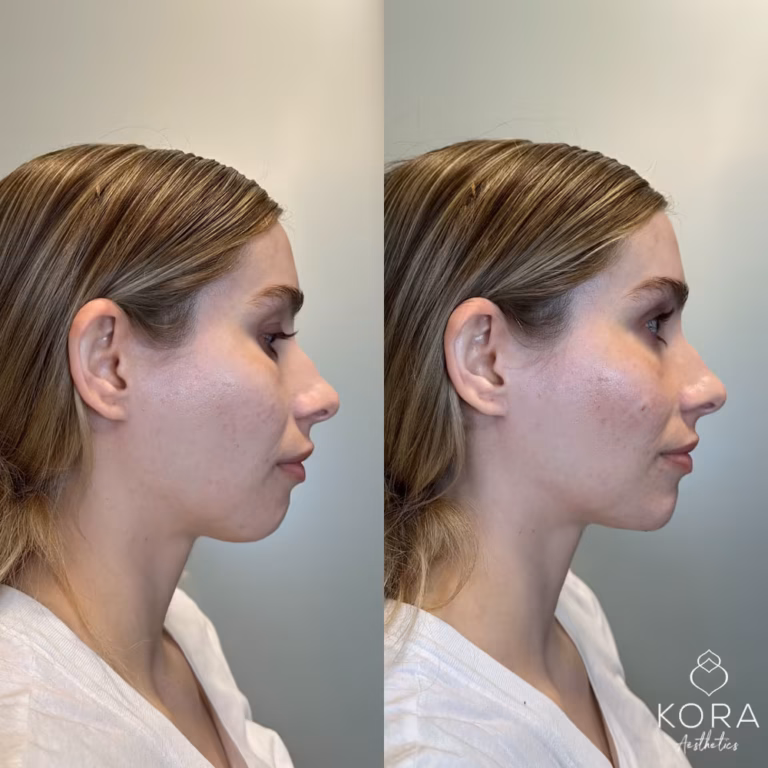 Dermal Filler Chin Fillers patient #379 before and after