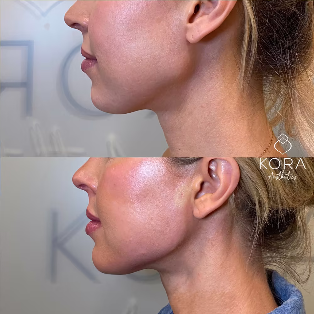 Profile before and after view demonstrating jawline filler creating a sharp, structured mandibular angle in Scottsdale