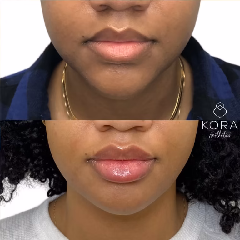 Dermal Filler Jawline Fillers patient #326 before and after