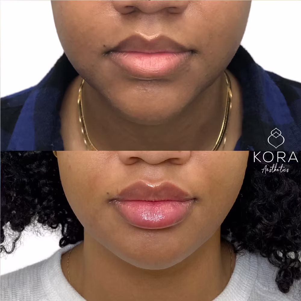 Frontal close-up before and after view showcasing dermal filler enhancing jawline structure and lip fullness in Scottsdale