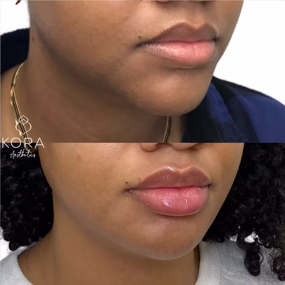 Angled profile before and after view showing dermal filler defining the jawline edge and enhancing lower face balance in Scottsdale