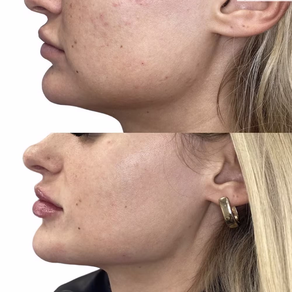 Profile before and after photo showing dermal filler strengthening the jawline and chin projection in Scottsdale