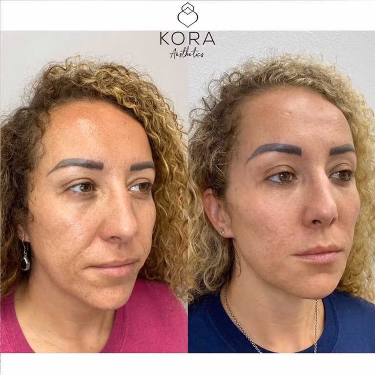 Dermal Filler Smile Lines patient #349 before and after