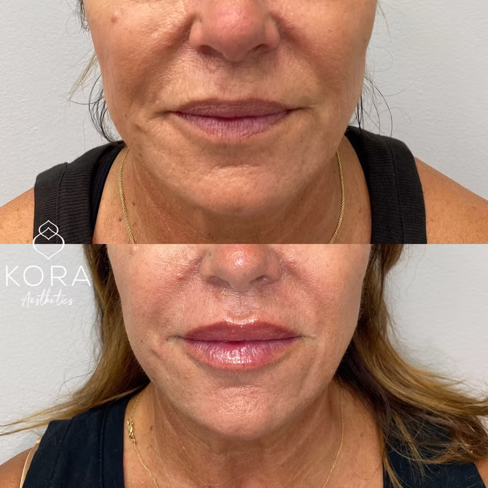 Close-up before and after photo showing dermal filler softening smile lines and plumping the lips in Scottsdale