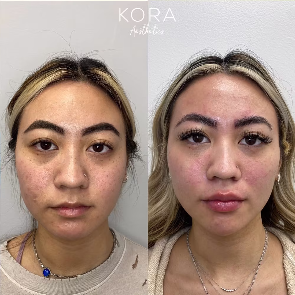 Frontal before and after view showing under eye dermal filler restoring volume to hollow tear troughs in Scottsdale