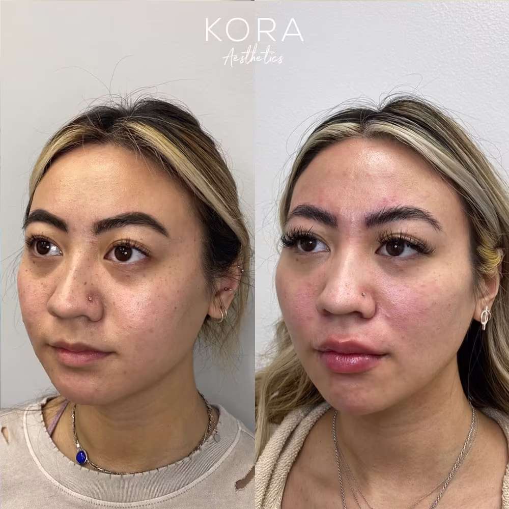 Three-quarter angle before and after view demonstrating under eye filler smoothing the tear trough transition in Scottsdale