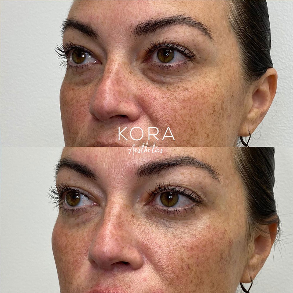 Close-up before and after view showing tear trough dermal filler softening under eye hollows and fine lines in Scottsdale