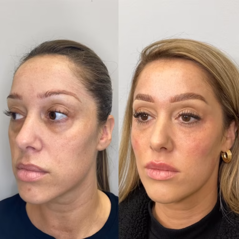 Dermal Filler Under Eye Fillers patient #333 before and after