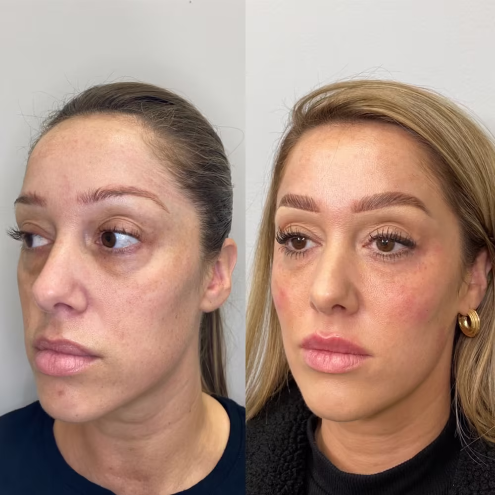 Three-quarter angle before and after view displaying under eye filler restoring volume to dark, sunken tear troughs in Scottsdale
