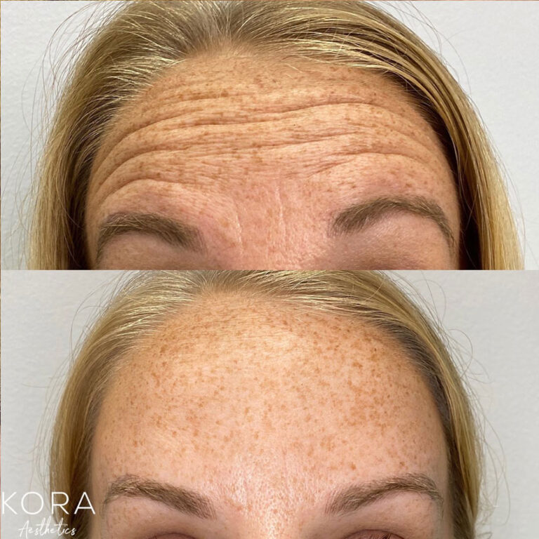 Dysport Forehead Lines Wrinkles patient #385 before and after
