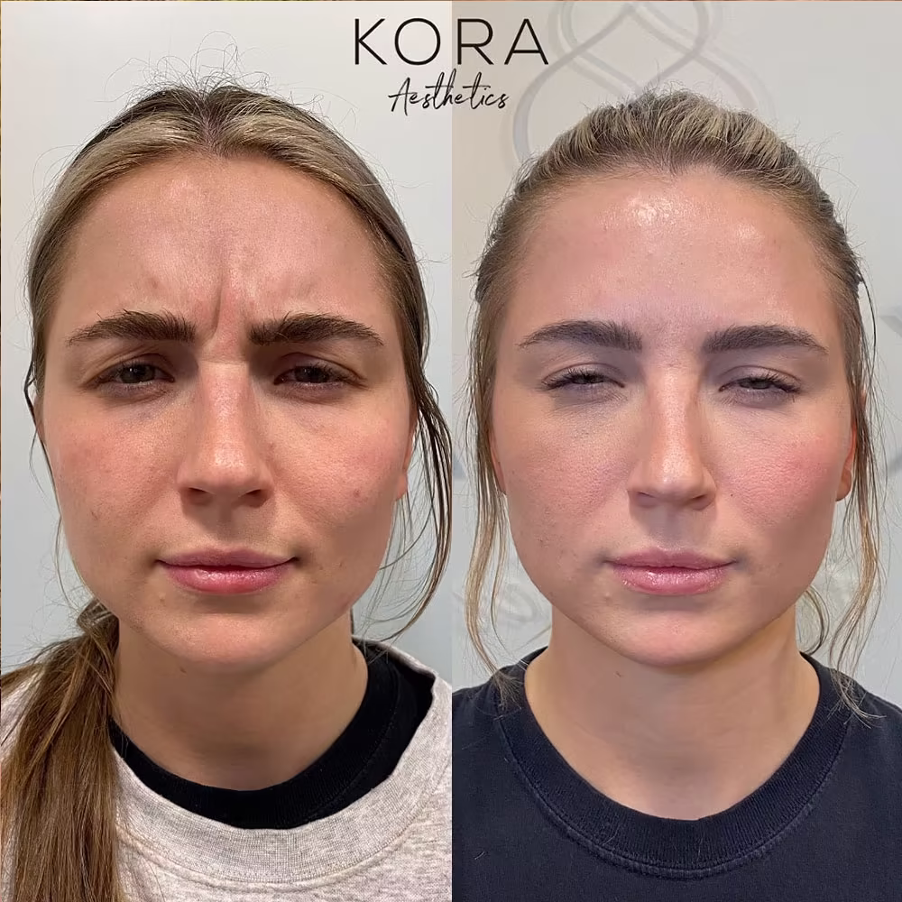 Before and after full face comparison showing smoothing of glabellar frown lines between the brows in Scottsdale