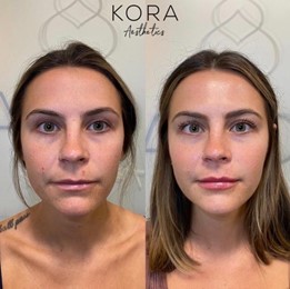 Front view before and after facial balancing with dermal filler showing improved facial symmetry, cheek contour, and lip enhancement in Scottsdale