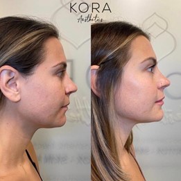 Side profile before and after facial balancing with dermal filler showing enhanced cheek contour, chin projection, and jawline definition in Scottsdale