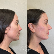 Side profile before and after facial balancing with dermal filler showing improved facial proportions, subtle volume support, and refined profile definition in Scottsdale
