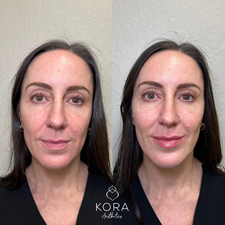 Front view before and after facial balancing with dermal filler showing improved symmetry, subtle lip enhancement, and better facial balance in Scottsdale