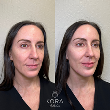 Before and after three-quarter facial view showing facial balancing with dermal filler, including improved cheek support, lip fullness, and facial harmony in Scottsdale