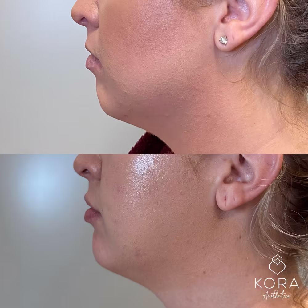 Close-up profile before and after showing chin filler projection in Scottsdale