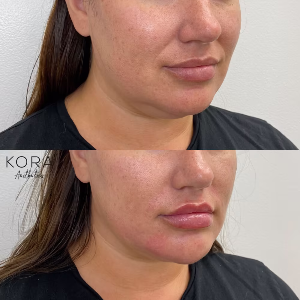 Angled view before and after chin filler treatment enhancing lower facial structure in Scottsdale