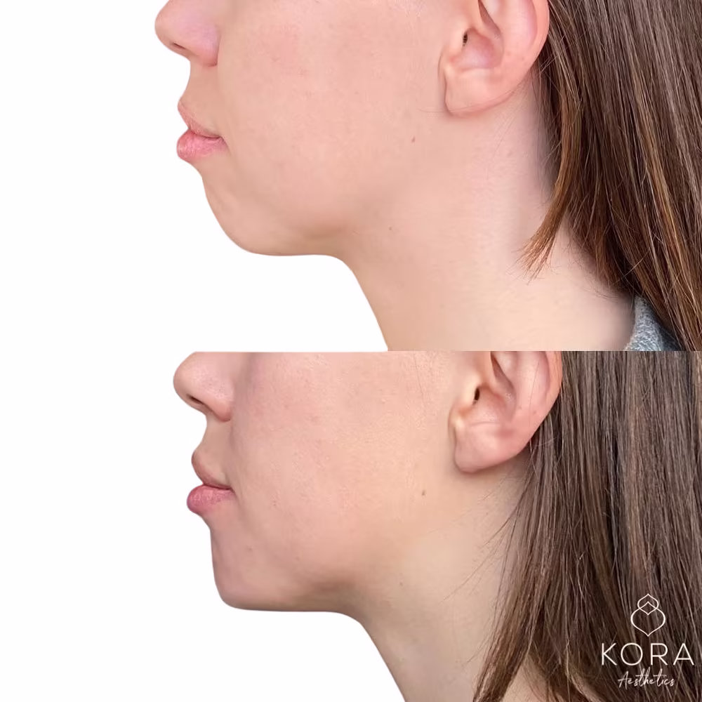 Profile before and after of chin filler treatment balancing lower face projection in Scottsdale