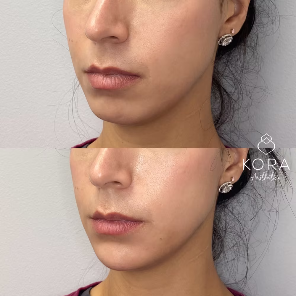 Three-quarter angle view before and after chin filler reshaping in Scottsdale
