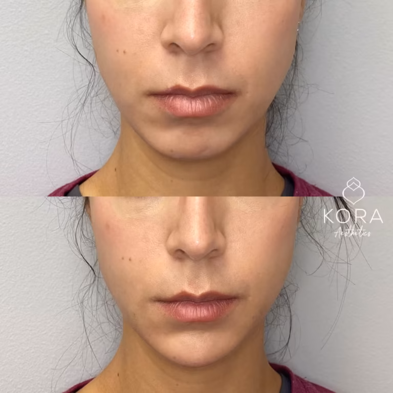 Juvederm Chin Fillers patient #362 before and after