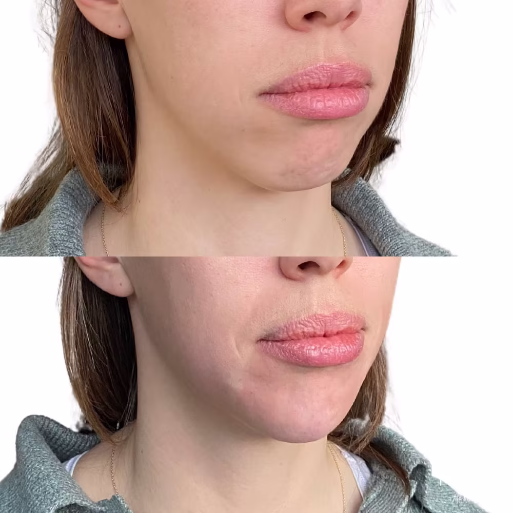 Three-quarter angle before and after chin filler treatment improving lower face shape in Scottsdale