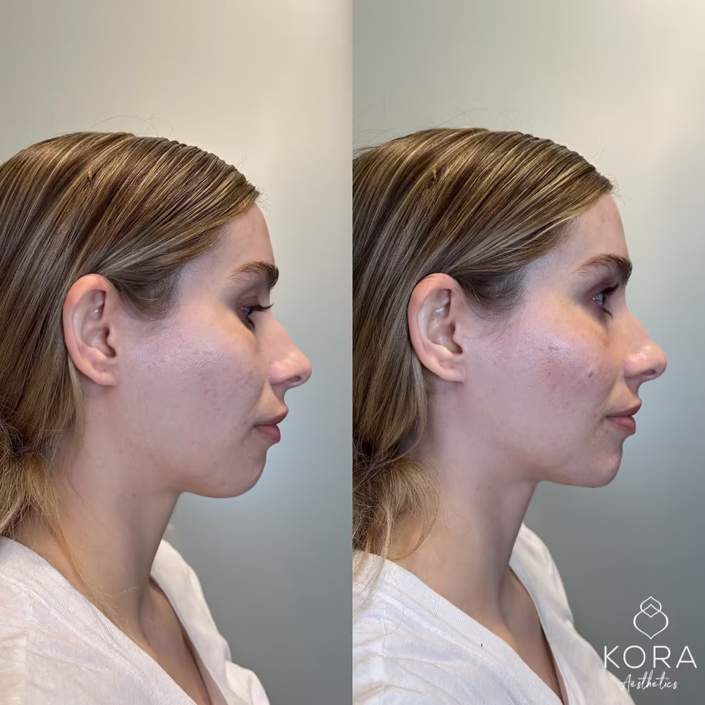Side profile before and after of chin filler enhancing facial balance and jawline linearity in Scottsdale
