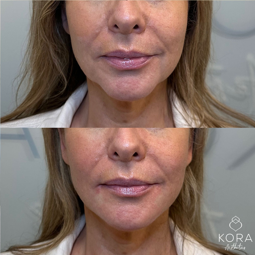 Frontal view before and after jawline filler treatment enhancing lower face structure in Scottsdale
