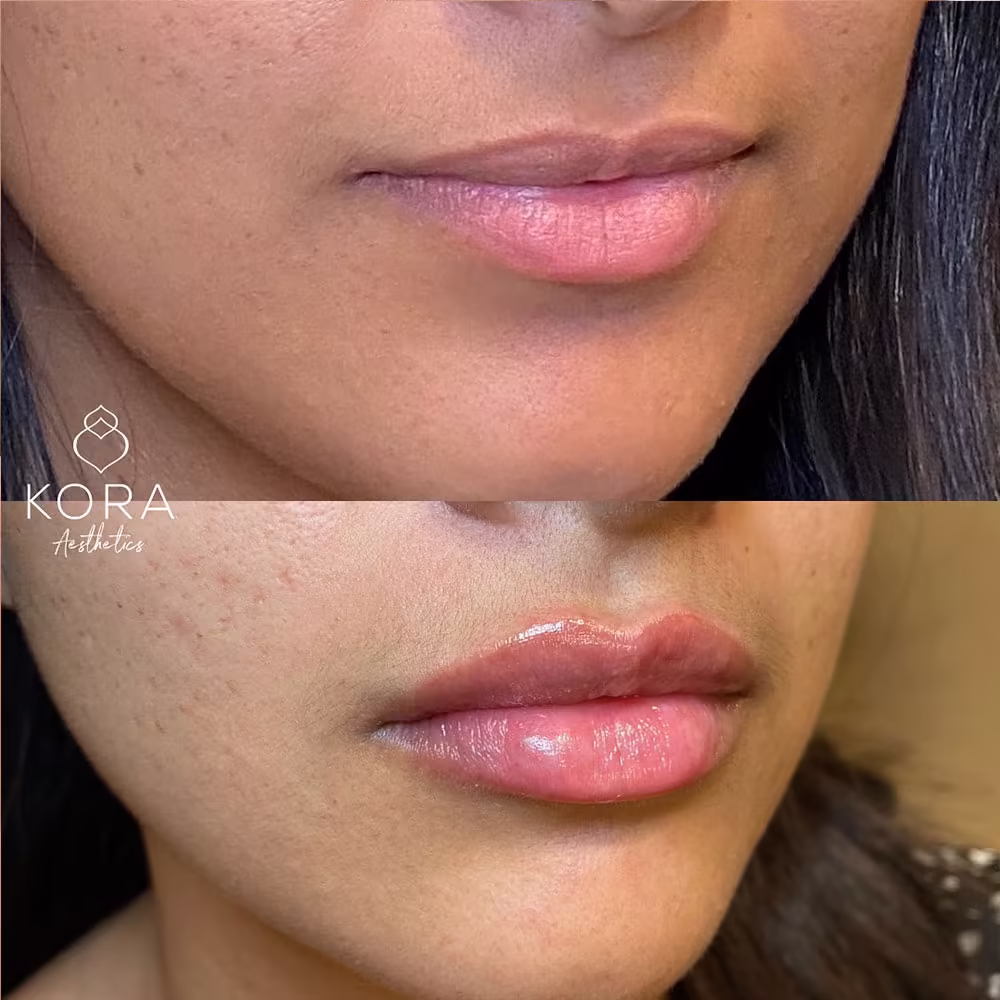 Three-quarter angle before and after view showing lip filler volume enhancement and Cupid's bow contouring in Scottsdale