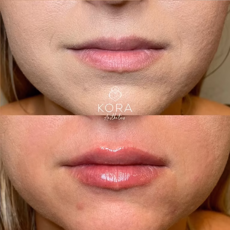 Juvederm Lips Fillers patient #390 before and after