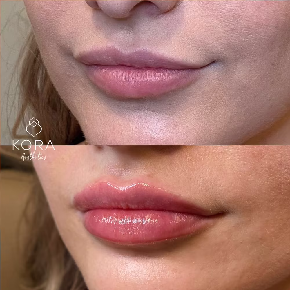 Angled view before and after showing enhanced lip fullness and defined lip border in Scottsdale